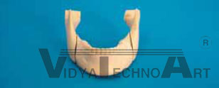 Mandible, fractured, Clip